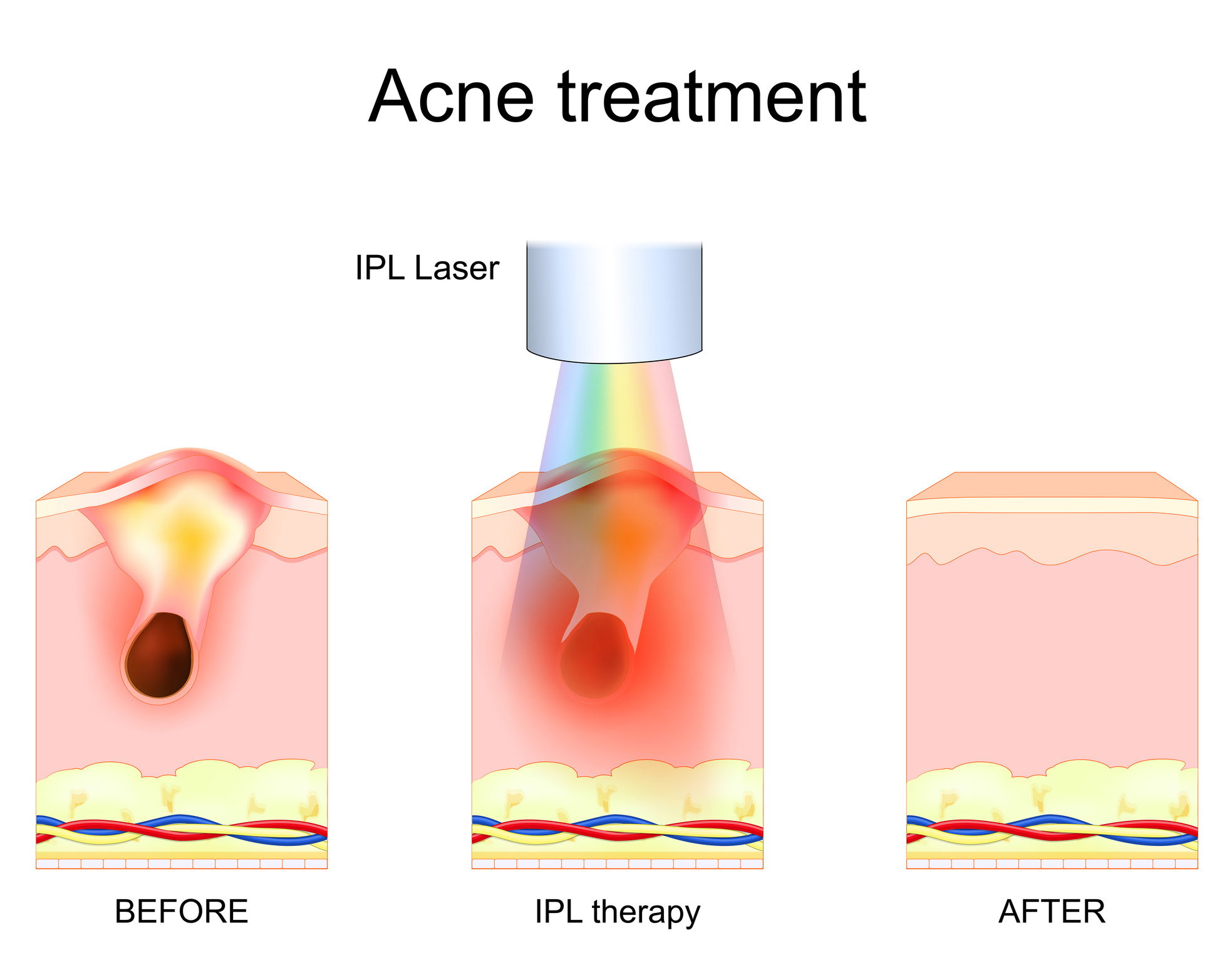 IPL photofacial treatment