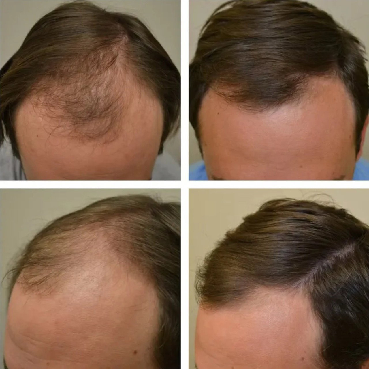 Hair rejuvenation treatment