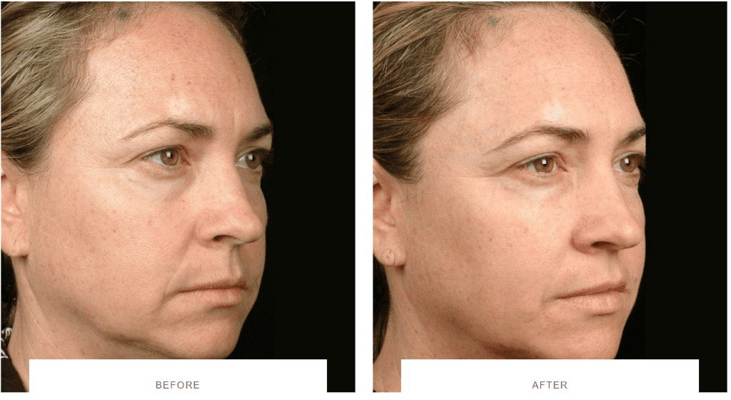 Laser skin resurfacing treatment